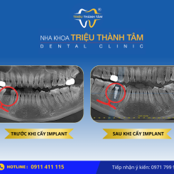 Cấy ghép implant