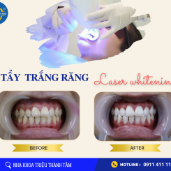 Tẩy trắng răng