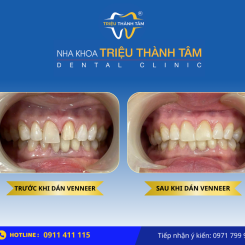 Mặt dán sứ Veneer