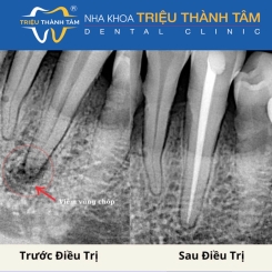 Điều trị tủy