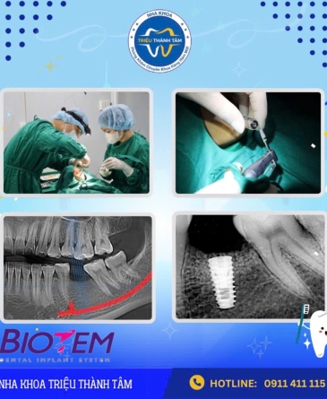 Trụ Implant Biotem Có Xuất Xứ, Đặc Điểm Và Giá Cả Như Thế Nào ?