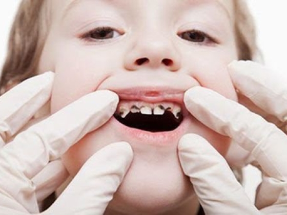 Viêm tủy răng sữa rất dễ xảy ra ở trẻ em, chẩn đoán và điều trị