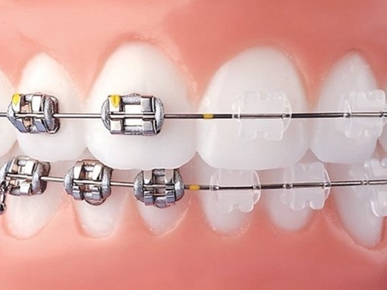 Niềng răng là gì? Lợi ích khi niềng răng