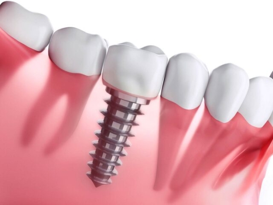 Cấy ghép implant là gì và những ai nên thực hiện?