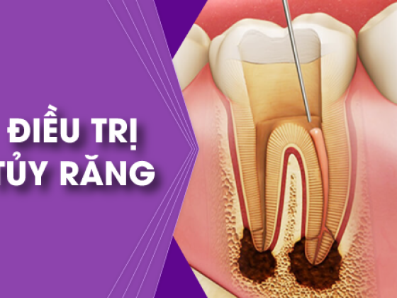 CHỮA TỦY RĂNG VÀ NHỮNG ĐIỀU CẦN BIẾT