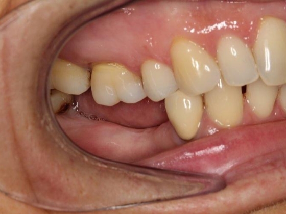 MẤT RĂNG LÂU NĂM CÓ TRỒNG LẠI ĐƯỢC KHÔNG ?