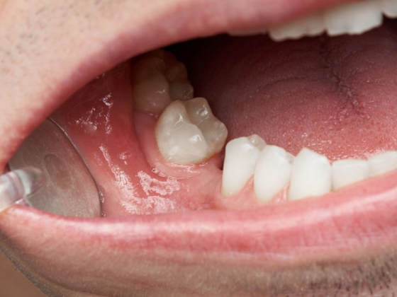 TIÊU XƯƠNG LÀ GÌ ? NHỮNG ẢNH HƯỞNG NGHIÊM TRỌNG CỦA TIÊU XƯƠNG HÀM