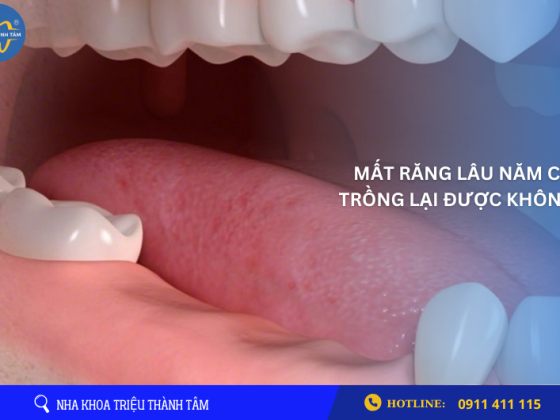 MẤT RĂNG LÂU NĂM CÓ PHƯƠNG PHÁP NÀO TRỒNG LẠI ĐƯỢC KHÔNG ?