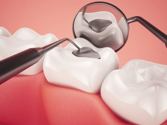 Trám răng rồi có bị sâu lại không?