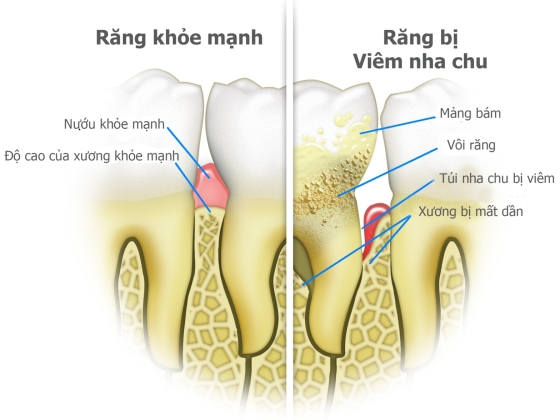 NHA CHU LÀ GÌ? NGUYÊN NHÂN GÂY BỆNH?
