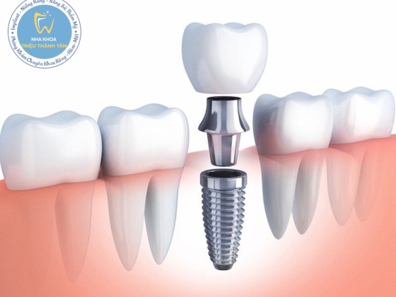 Vì sao nên cấy ghép Implant khi mất răng ?