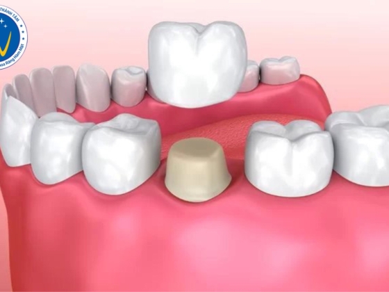 ĐIỀU TRỊ TỦY RĂNG CÓ NÊN BỌC SỨ KHÔNG ?